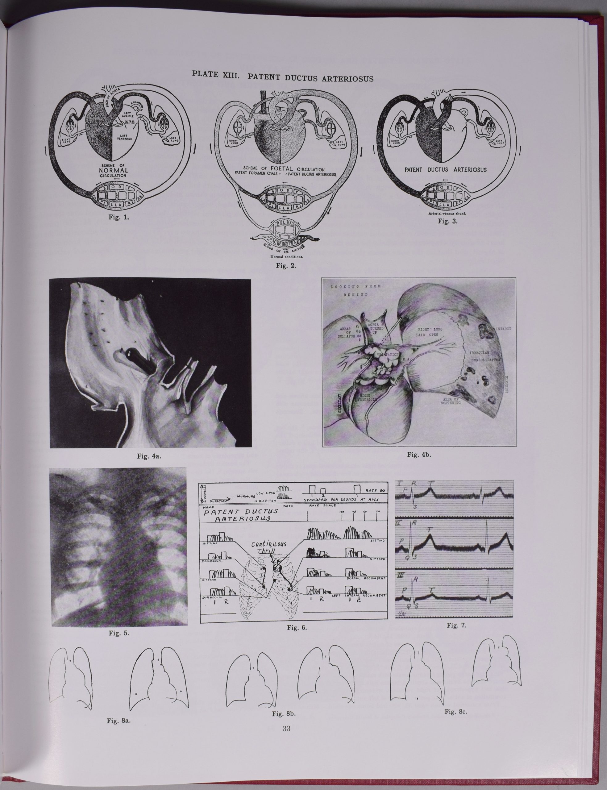 Photographie de la page 33 de l’Atlas of Congenital Cardiac Disease de Maude Abbott, noir et blanc. En haut de la page, l’inscription « Plate XIII. Patent Ductus Arteriosus » et on y voit 11 figures représentant des artères cardiaques en dessins et images.