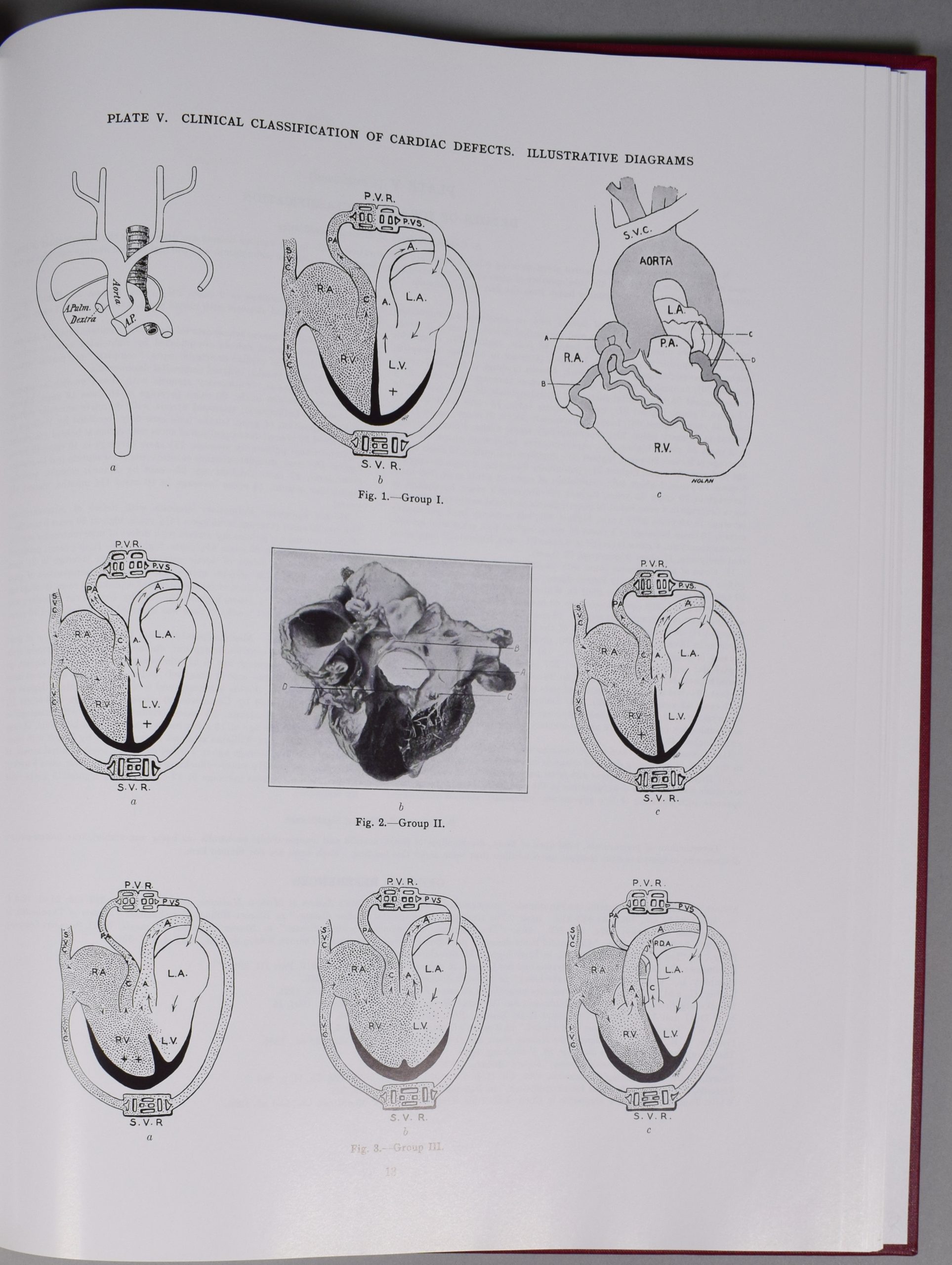 Photographie de la page 12 de l’Atlas de Maude Abbott. En haut de la page, l’inscription « Plate V. Clinical Classification of Cardiac Defects. Illustrative Diagrams » et on y voit 9 figures représentant différentes parties du cœur en images.