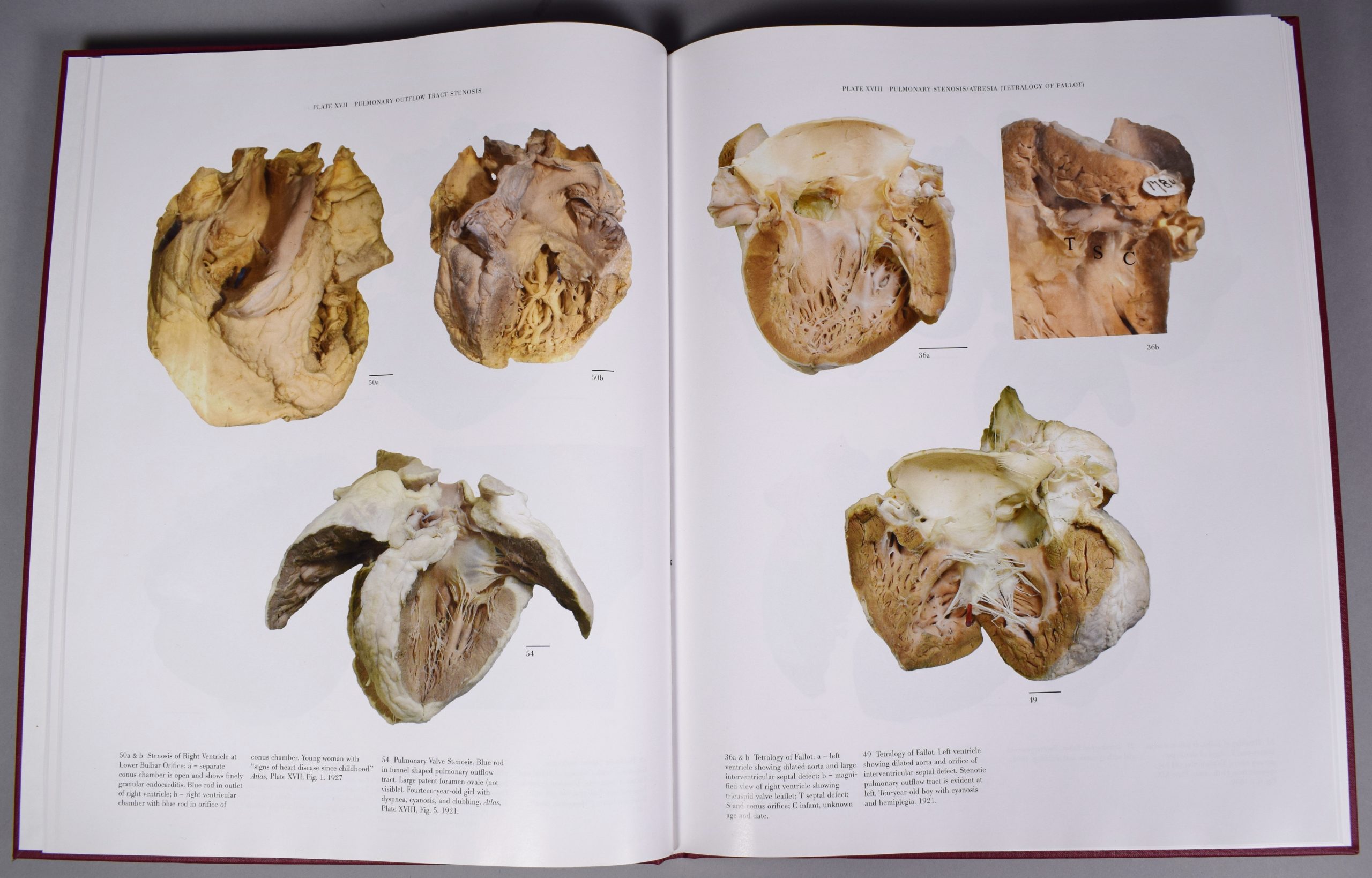 Photographie en couleur de deux pages de l’Atlas of Congenital Cardiac Disease de Maude Abbott. La page de gauche, « Plate XVII Pulmonary Outflow Tract Stenosis » et celle de droite « Plate VXIII Pulmonary Stenosis/Atresia (Tetralogy of Fallot) », présentent des spécimens de cœurs en couleur, avec des explications au bas de la page. 