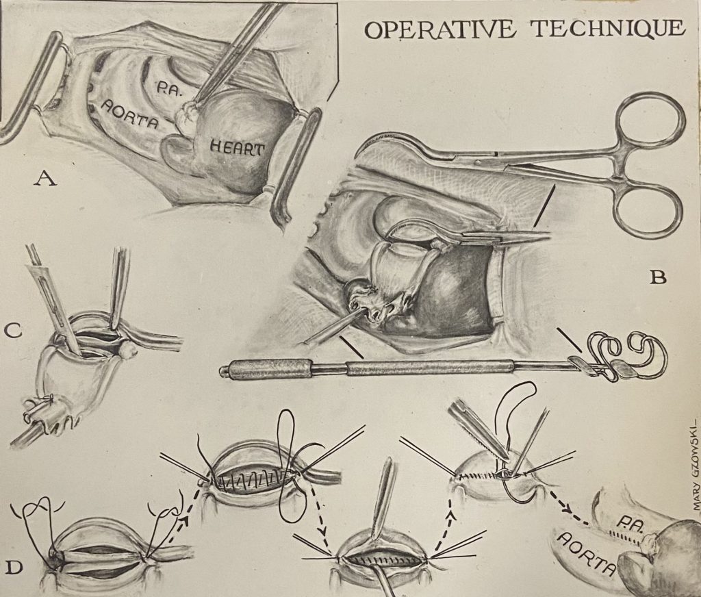 Illustration en noir et blanc d'une aorte en cours d'incision, puis en cours de suture. Plusieurs petites illustrations décrivent le processus par étapes.