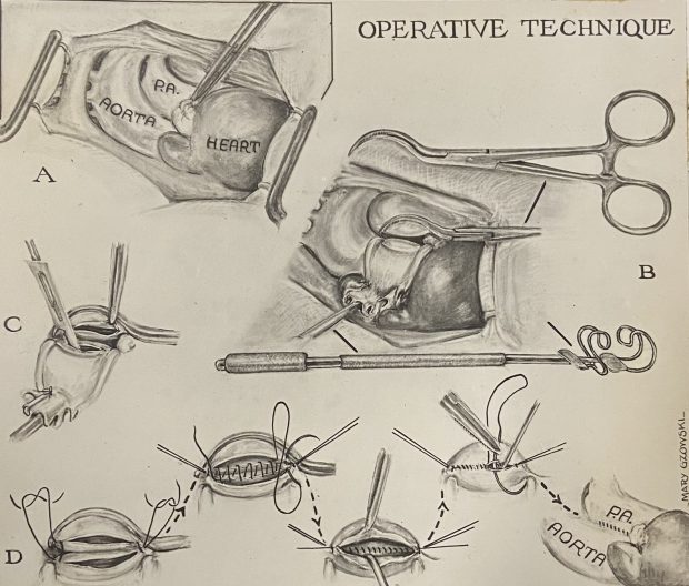 Illustration en noir et blanc d'une aorte en cours d'incision, puis en cours de suture. Plusieurs petites illustrations décrivent le processus par étapes.