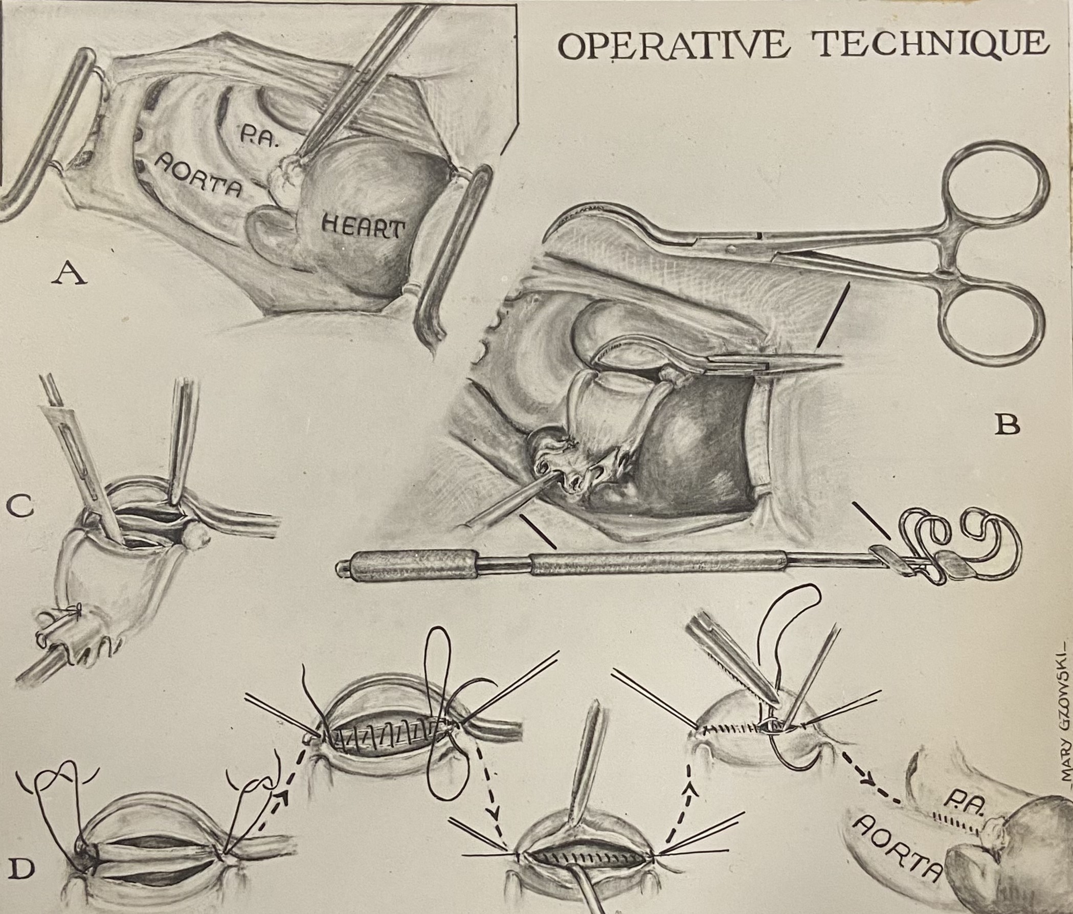 Illustration en noir et blanc d'une aorte en cours d'incision, puis en cours de suture. Plusieurs petites illustrations décrivent le processus par étapes. 