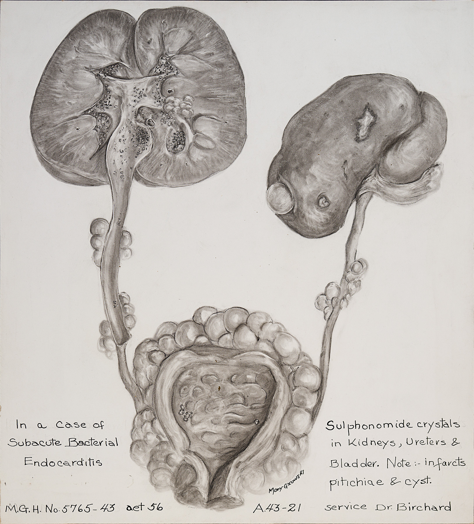 Illustration en noir et blanc de cristaux de sulfonamide présents dans les reins, les uretères et la vessie. 