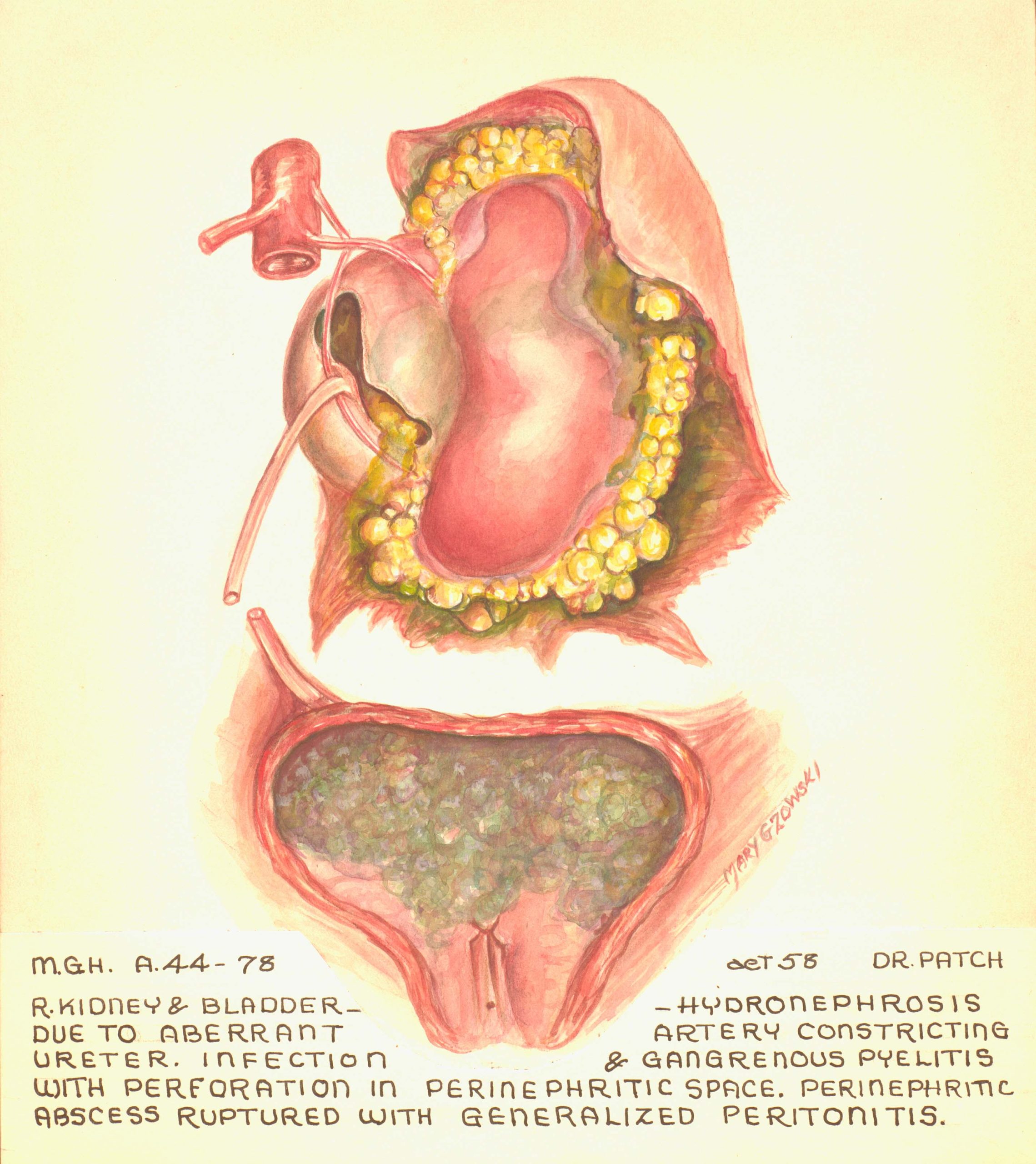 Illustration en couleur du rein droit et de la vessie présentant une hydronéphrose. 
