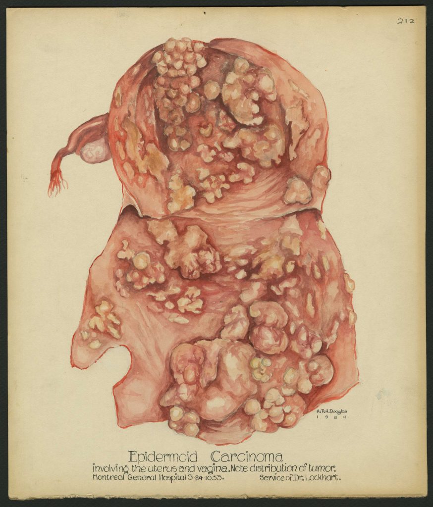 Illustration médicale réalisée à l'aquarelle dans des tons rouges et orangés représentant une affection utérine. L'image, annotée au centre en bas, est signée et datée à droite sous l’illustration.