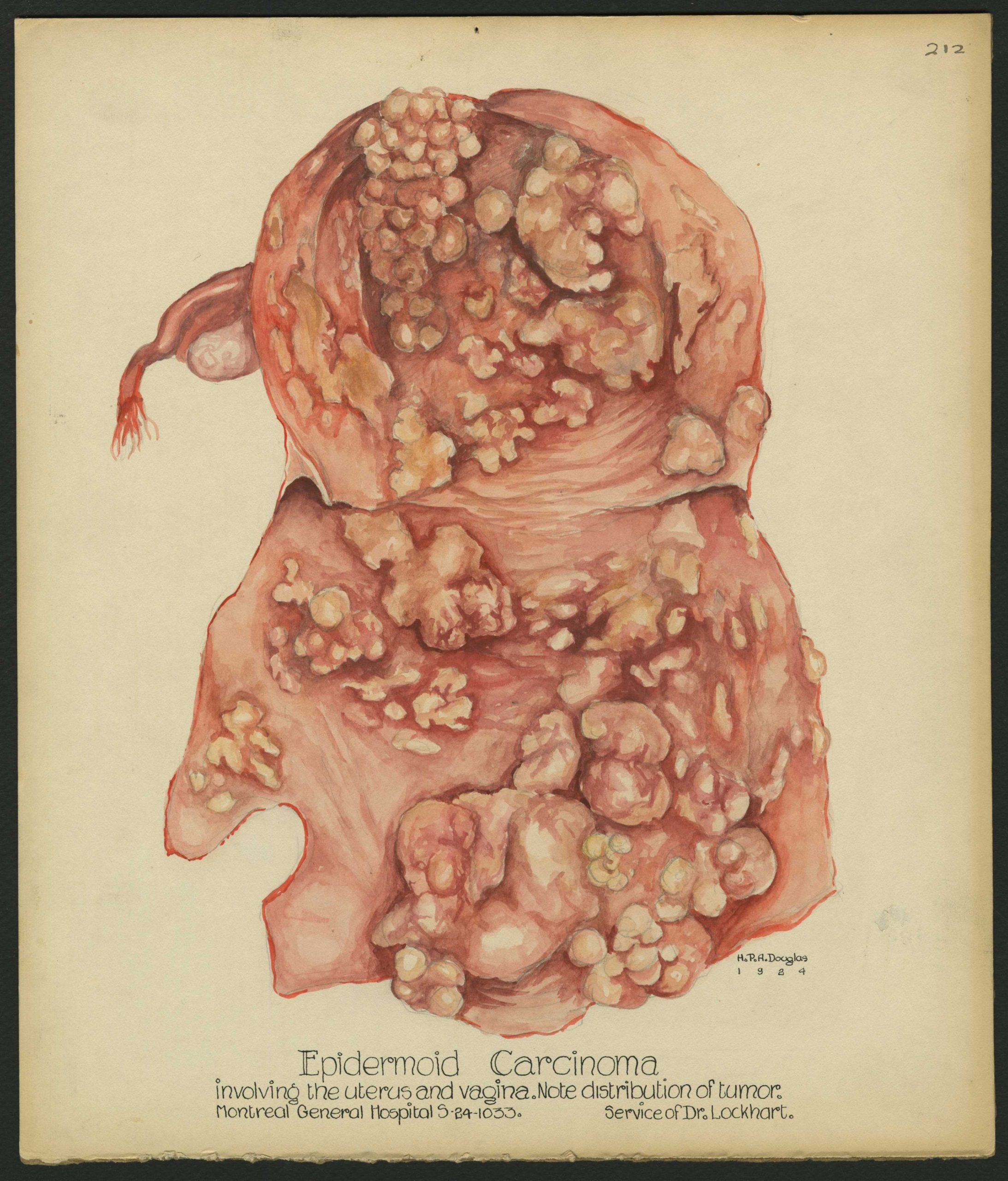 Illustration médicale réalisée à l'aquarelle dans des tons rouges et orangés représentant une affection utérine. L'image, annotée au centre en bas, est signée et datée à droite sous l’illustration. 