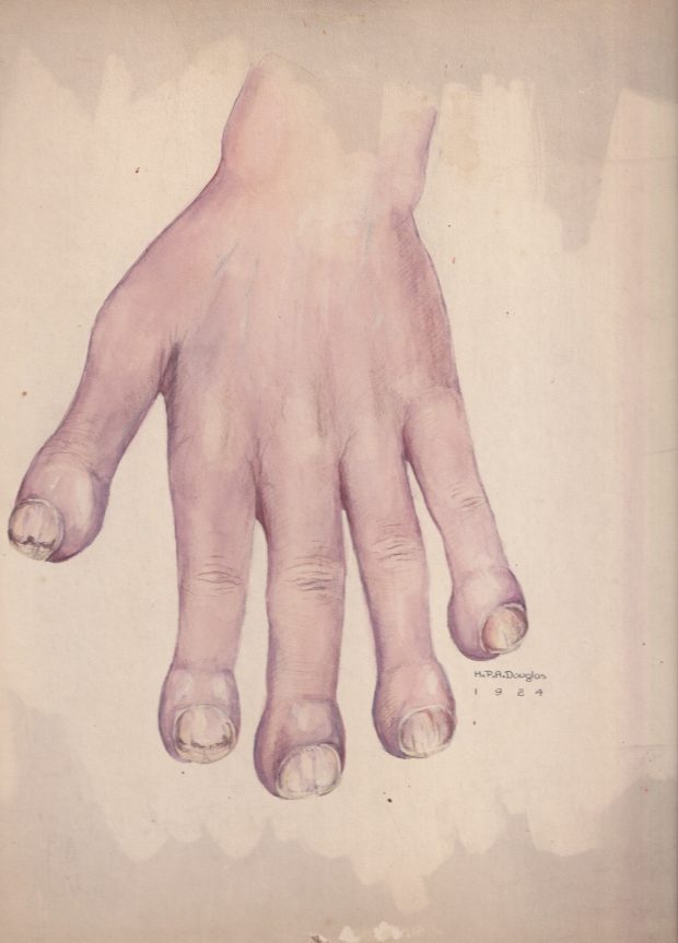 Illustration médicale réalisée à l'aquarelle dans des tons violets et pêche, montrant une main aux doigts enflés et aux ongles abîmés. Signée et datée en bas à droite.