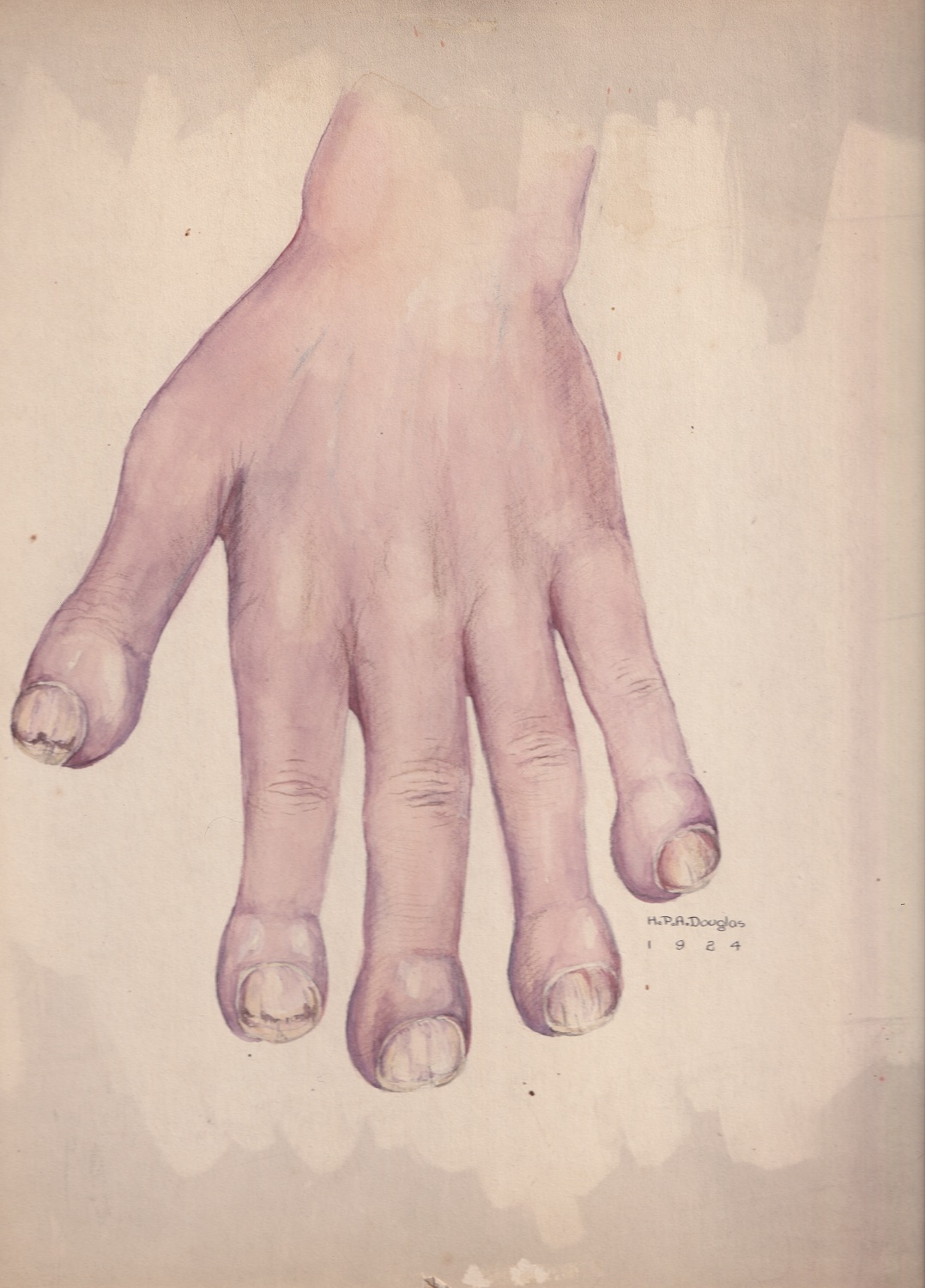 Illustration médicale réalisée à l'aquarelle dans des tons violets et pêche, montrant une main aux doigts enflés et aux ongles abîmés. Signée et datée en bas à droite. 