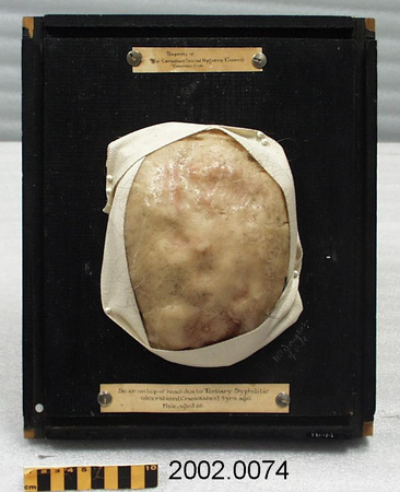 Photo en couleur du moulage médical d’un crâne bosselé, monté sur carton noir. 