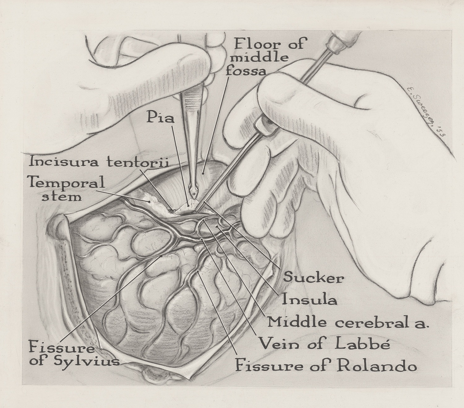 Illustration en noir et blanc montrant des mains gantées opérant un cerveau.