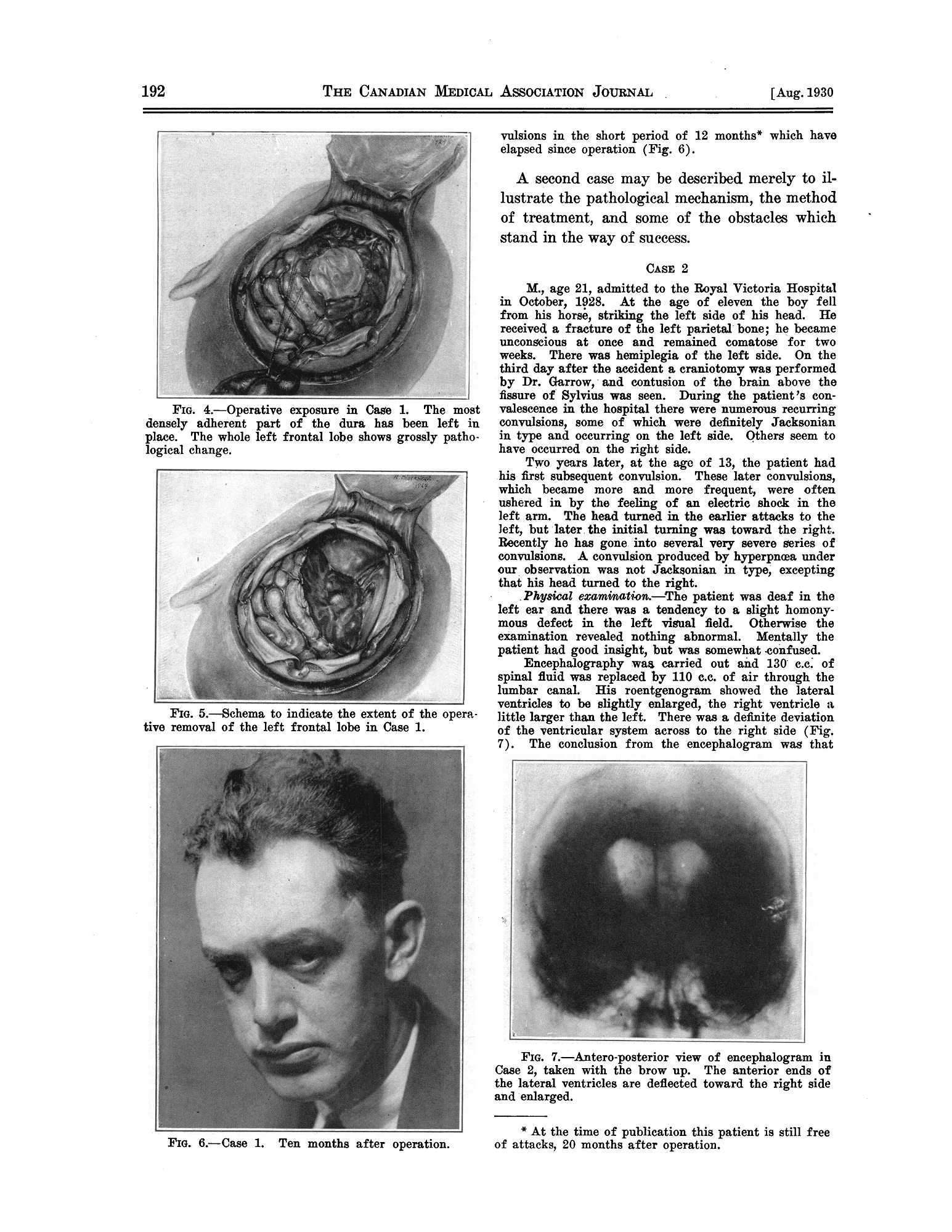 Article de revue en noir et blanc montrant la figure d'un homme et un cerveau exposé dans un crâne ouvert. 