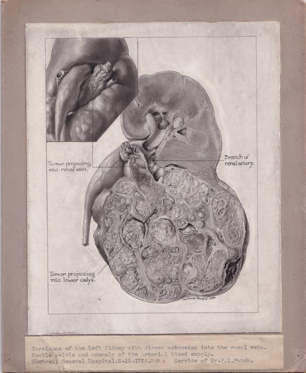 Illustration médicale en noir et blanc montée sur carton gris, avec une étiquette apposée sous le dessin. Le dessin, qui présente une maladie rénale, est réalisé à la poudre de carbone et signé en bas à droite.