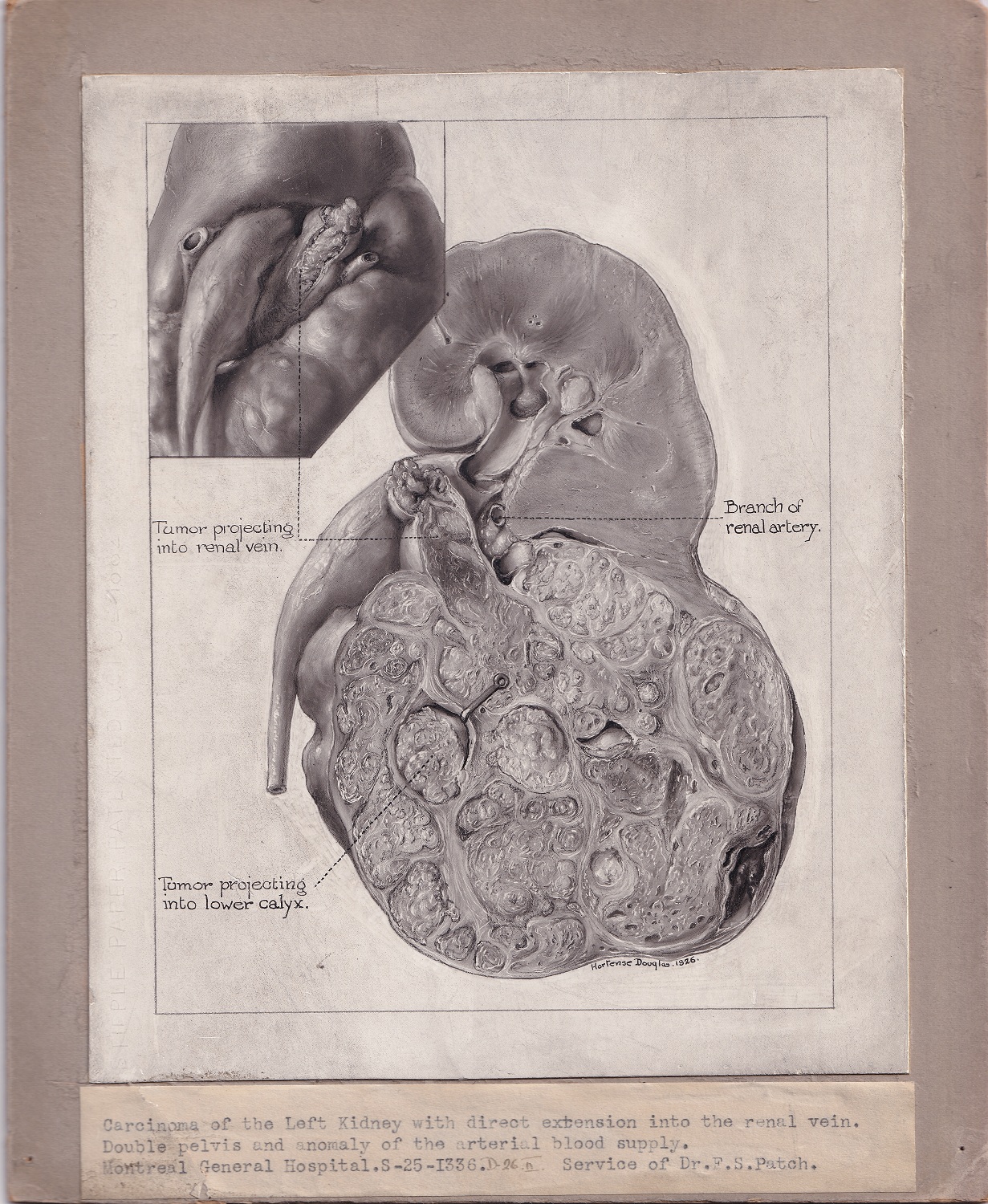 Illustration médicale en noir et blanc montée sur carton gris, avec une étiquette apposée sous le dessin. Le dessin, qui présente une maladie rénale, est réalisé à la poudre de carbone et signé en bas à droite. 