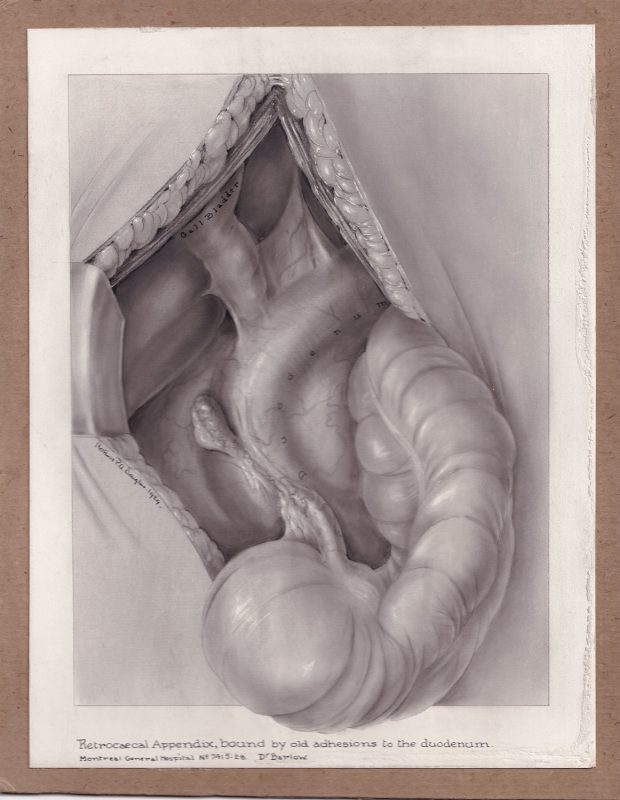 Illustration médicale en noir et blanc réalisée à la poudre de carbone et montée sur carton brun. Le dessin est entouré d'une bordure blanche, et une partie déborde de la forme rectangle. Des annotations sous et dans l'illustration, qui est signée au milieu à gauche.