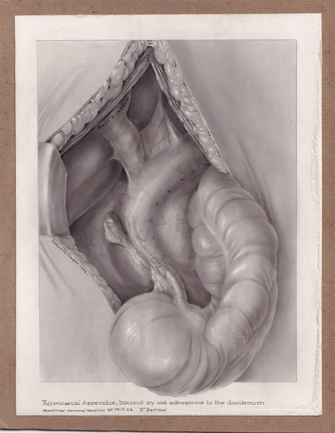 Illustration médicale en noir et blanc réalisée à la poudre de carbone et montée sur carton brun. Le dessin est entouré d'une bordure blanche, et une partie déborde de la forme rectangle. Des annotations sous et dans l'illustration, qui est signée au milieu à gauche. 