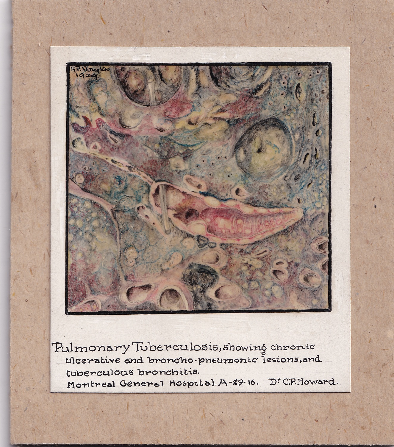 Illustration médicale réalisée au crayon de couleur et montée sur carton brun. Le dessin, encadré de noir, est signé en haut à gauche et annoté au bas. 