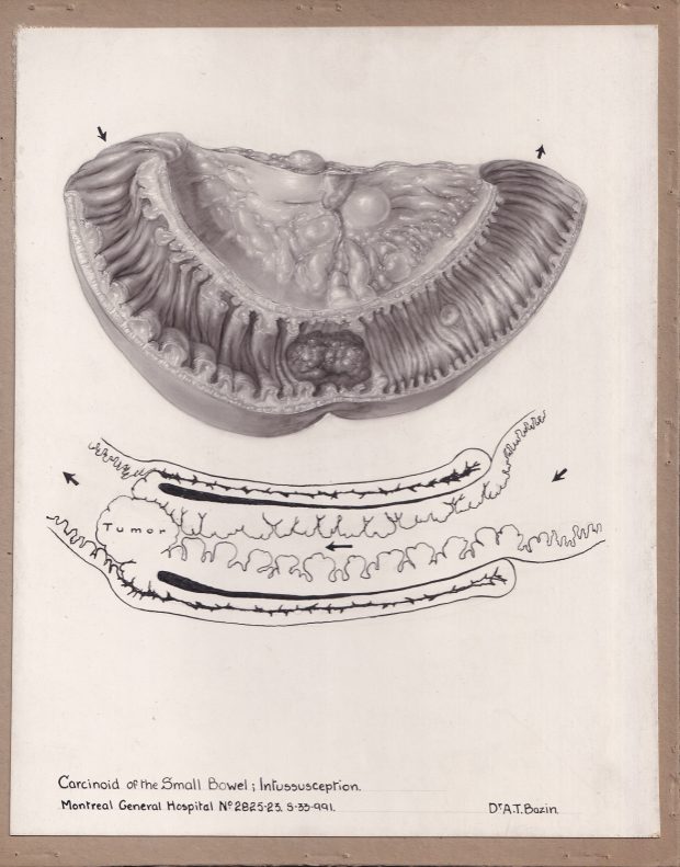 Illustration médicale en noir et blanc réalisée avec plusieurs médiums, montrant un trouble intestinal. Illustration du haut à la poudre de carbone, dessin du bas au crayon. Légende au bas du dessin.