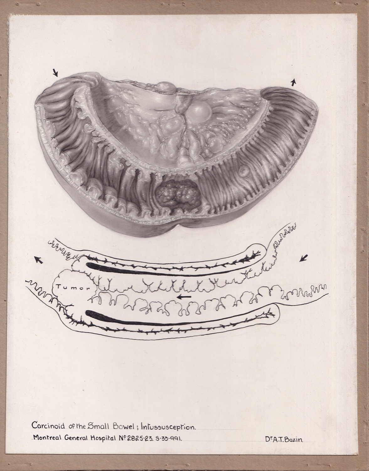 Illustration médicale en noir et blanc réalisée avec plusieurs médiums, montrant un trouble intestinal. Illustration du haut à la poudre de carbone, dessin du bas au crayon. Légende au bas du dessin. 