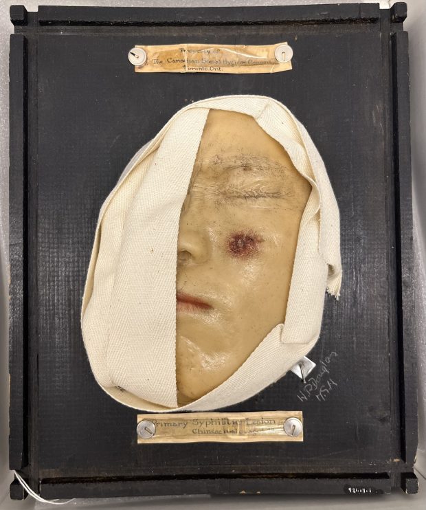 Photo en couleur du moulage médical d’un visage d'homme avec une plaie rouge sur la joue, monté sur carton noir.