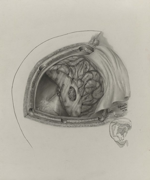 Illustration médicale en noir et blanc montrant la vue en plongée d'une chirurgie neurologique. Signée et datée en bas à droite de l'image.