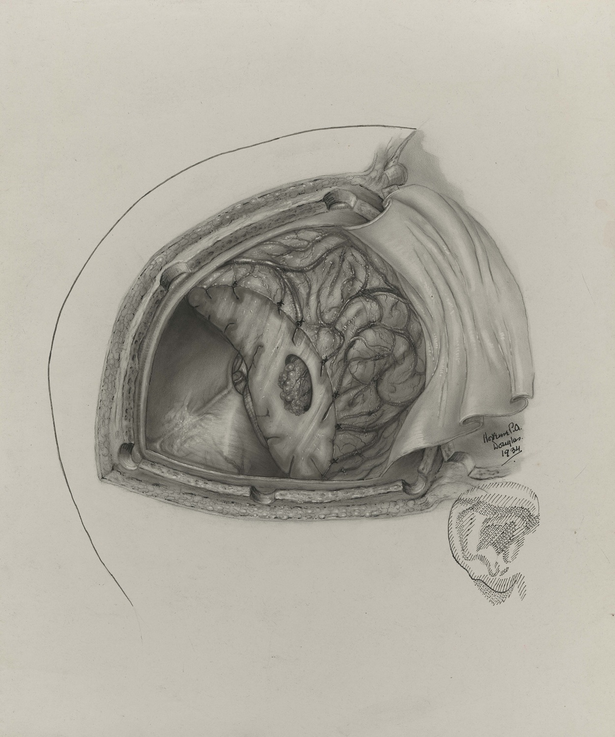 Illustration médicale en noir et blanc montrant la vue en plongée d'une chirurgie neurologique. Signée et datée en bas à droite de l'image.   