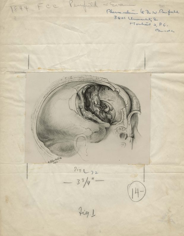 Illustration médicale en noir et blanc d’un crâne, signée et datée en bas à gauche, montée sur du papier journal froissé, avec des notes de publication.