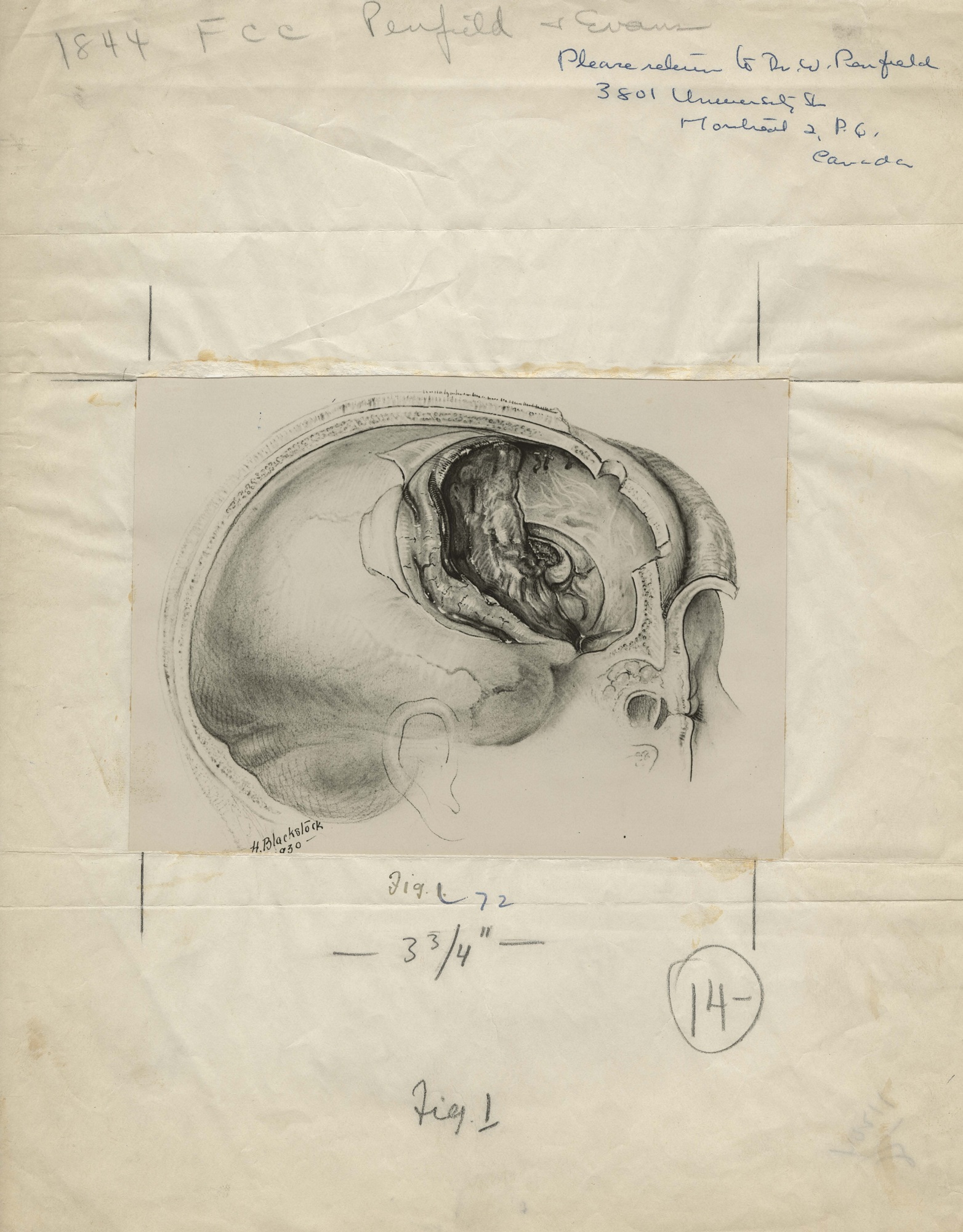 Illustration médicale en noir et blanc d’un crâne, signée et datée en bas à gauche, montée sur du papier journal froissé, avec des notes de publication. 