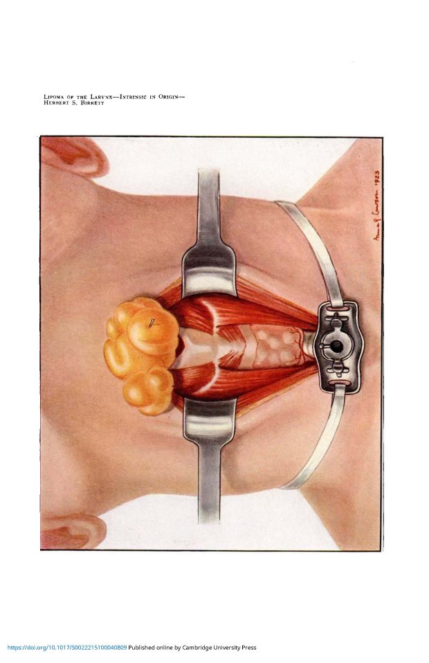 Illustration médicale en couleur d'une gorge maintenue ouverte par une pince pendant d'une chirurgie. Au bas de la gorge, une incision trachéotomique.