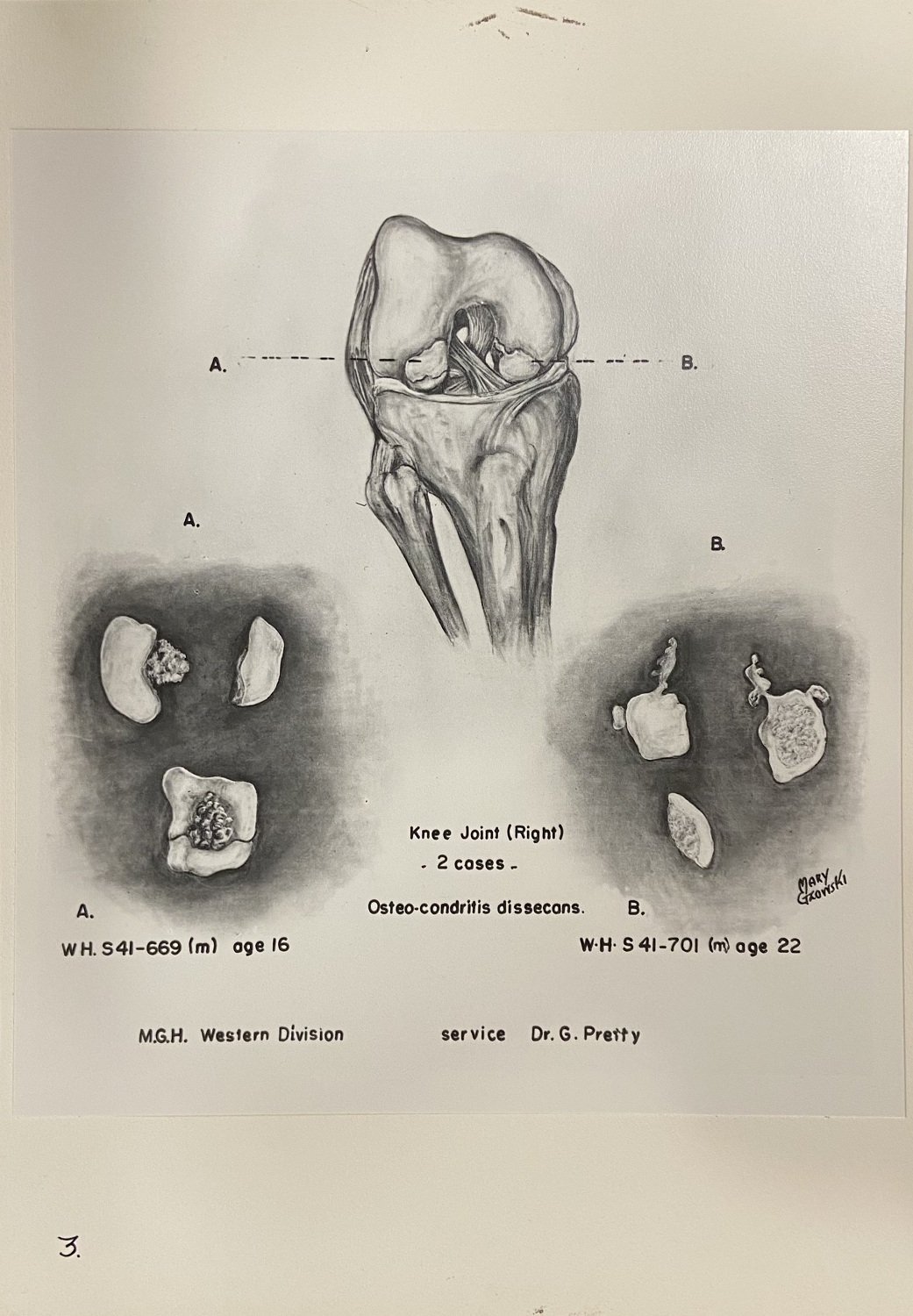 Illustration en noir et blanc d’une articulation du genou, en trois images : une vue d'ensemble et deux gros plans détaillant des parties de l'articulation. 