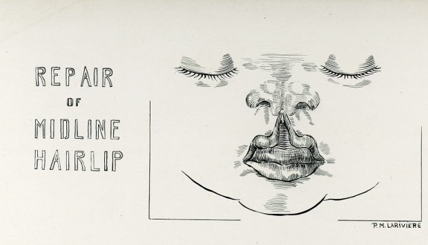 Illustration en noir et blanc d'un visage d'enfant avec la lèvre supérieure fendue et soulevée vers le nez. À gauche, le titre « Réparation d'une fente labiale médiane » et à droite, la signature de Pauline M. Larivière.