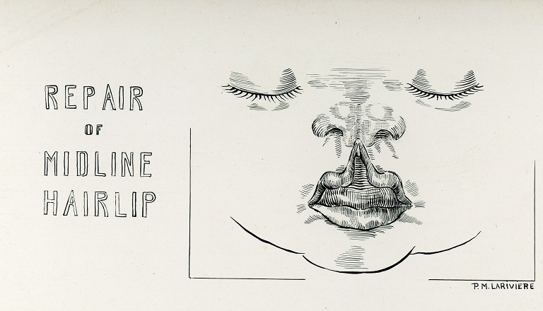 Illustration en noir et blanc d'un visage d'enfant avec la lèvre supérieure fendue et soulevée vers le nez. À gauche, le titre « Réparation d'une fente labiale médiane » et à droite, la signature de Pauline M. Larivière. 