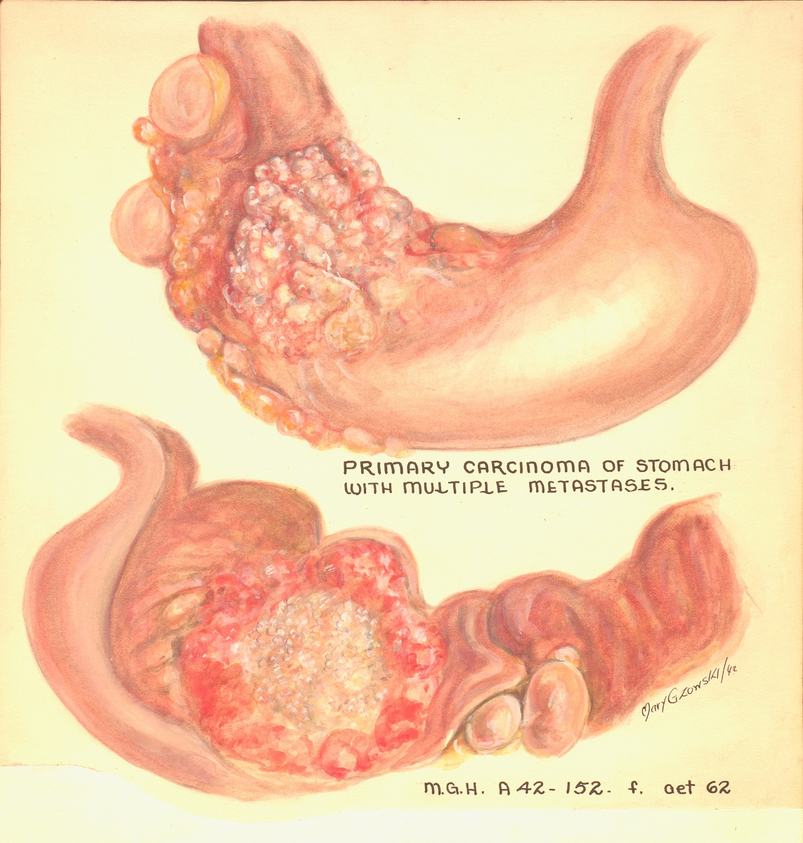 Illustration en couleur d'un estomac présentant des tumeurs cancéreuses. 