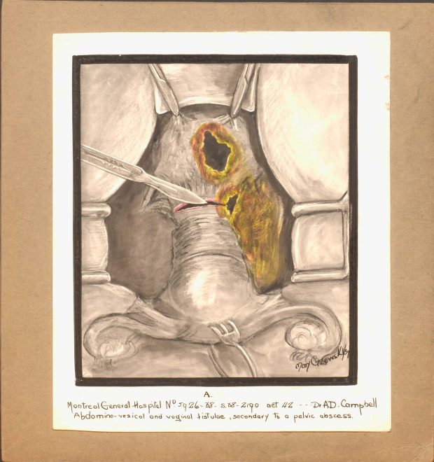 Illustration en couleur de fistules abdomino-vésicales et vaginales. Des pinces chirurgicales maintiennent la cavité ouverte, le chirurgien tient un scalpel.