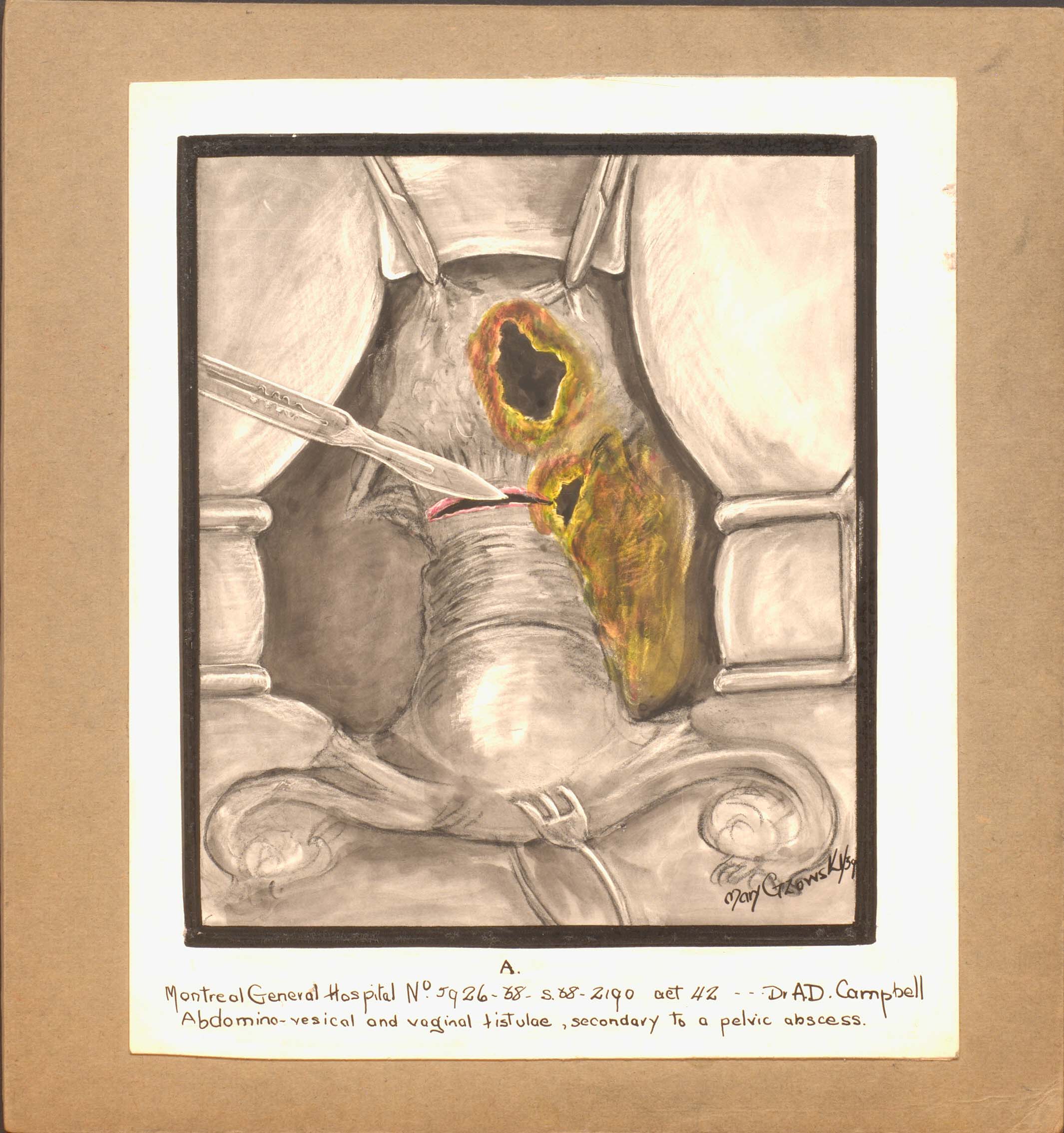 Illustration en couleur de fistules abdomino-vésicales et vaginales. Des pinces chirurgicales maintiennent la cavité ouverte, le chirurgien tient un scalpel. 