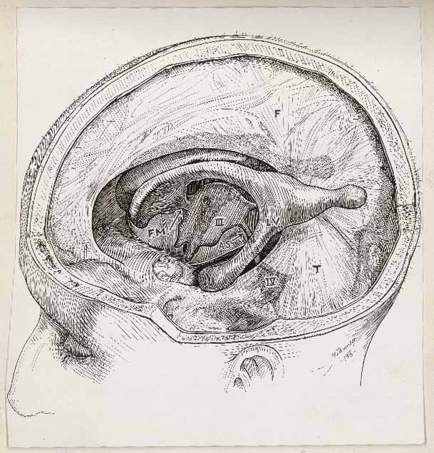 Illustration médicale réalisée au stylo montrant un crâne ouvert et une partie du cerveau.