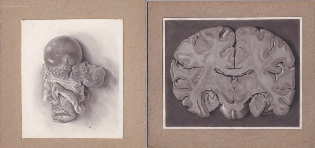 Deux illustrations médicales en tons, réalisées à la poussière de carbone sur papier crème, montées sur carton.