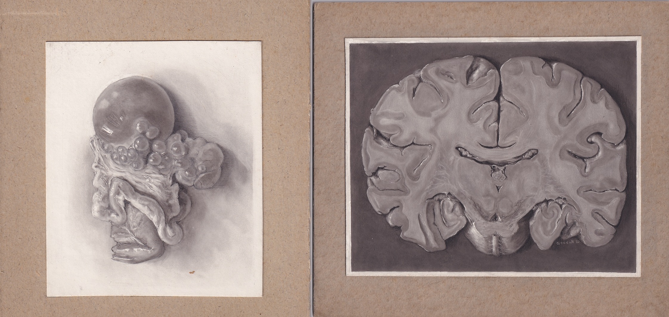 Deux illustrations médicales en tons, réalisées à la poussière de carbone sur papier crème, montées sur carton.